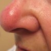 鼻の中のできものが痛い！原因や予防方法を紹介！